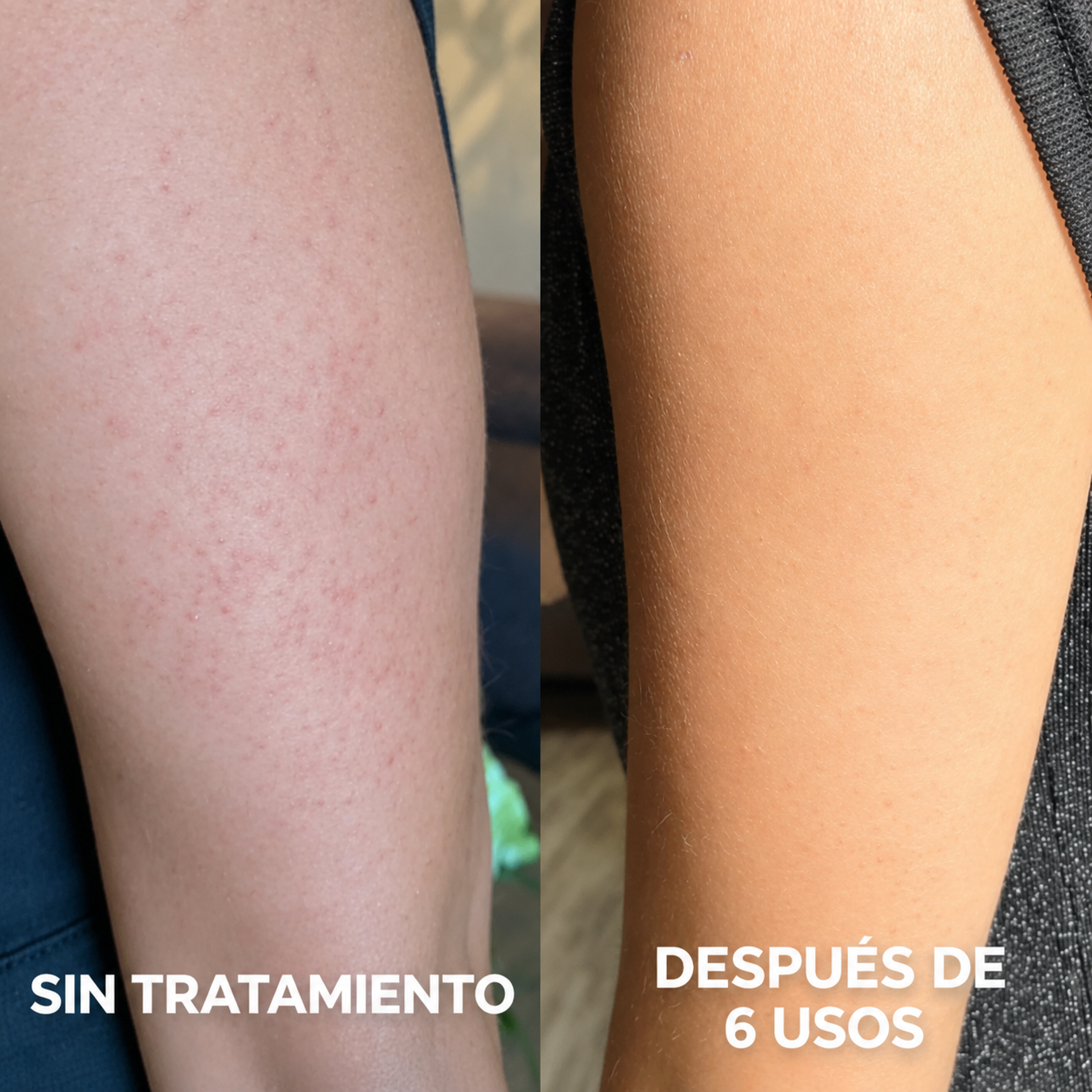 GLOVA™ — Crema Corporal para Suavizar la Textura Rugosa y los Puntitos Rojos